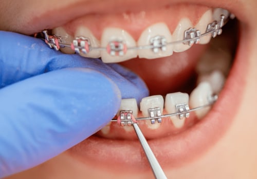 Applications of Clips and Retainers: A Comprehensive Overview